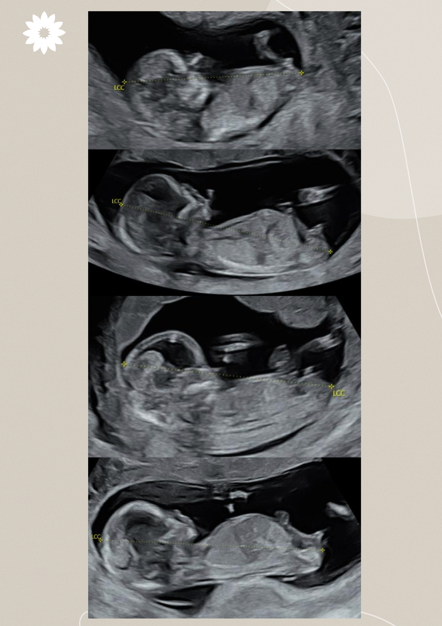 Comment reconnaître le sexe de bébé à l'échographie du 1er trimestre ?