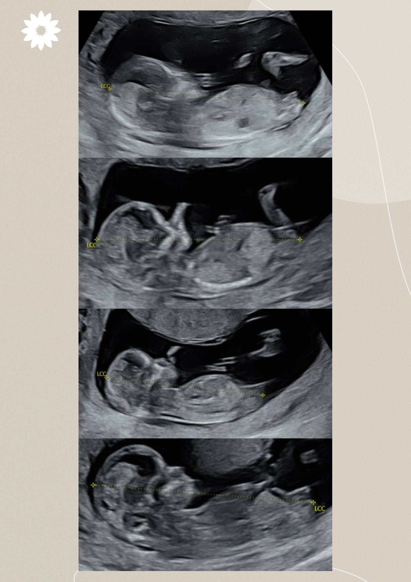 Comment reconnaître le sexe de bébé à l'échographie du 1er trimestre ?