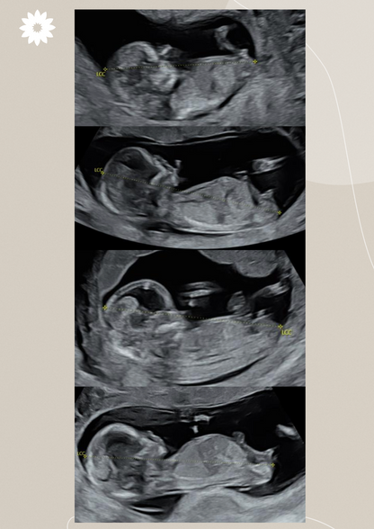 Comment reconnaître le sexe de bébé à l'échographie du 1er trimestre ?
