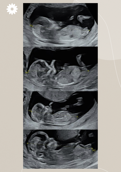 Comment reconnaître le sexe de bébé à l'échographie du 1er trimestre ?